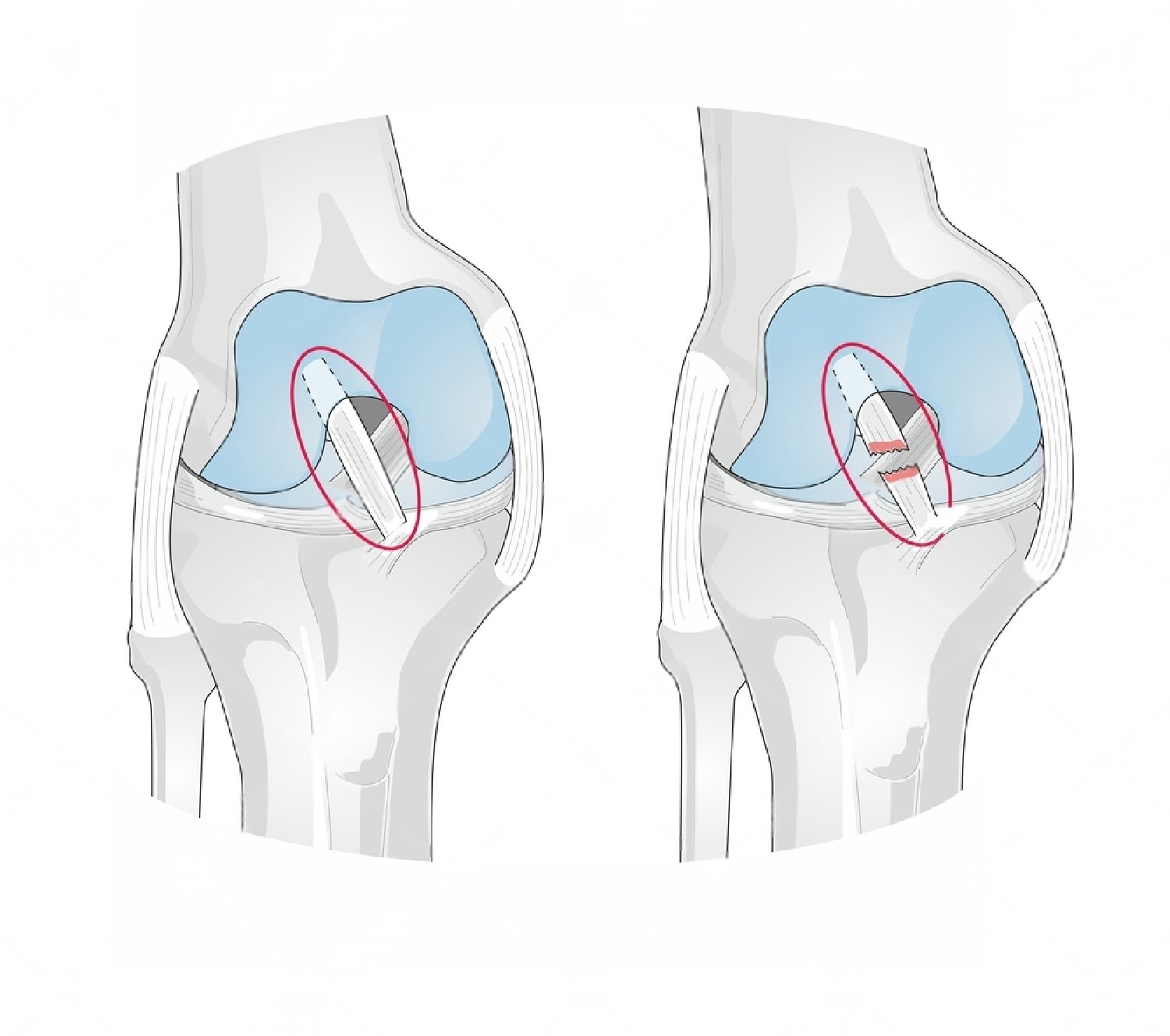 Anterior Cruciate Ligament Injury